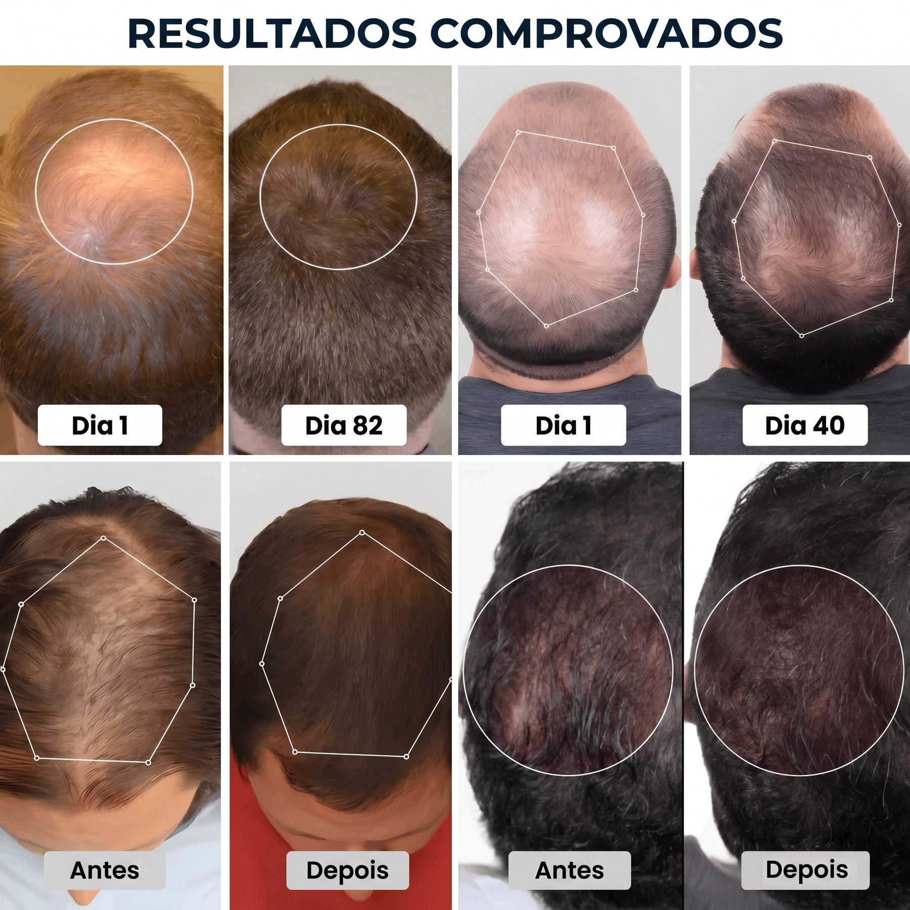Tecnologia LED para Crescimento Capilar